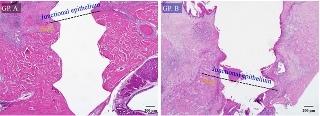 H-E-stained specimen slide: (a) untreated control group A (magnification ×40) and (b) silk-induced peri-implantitis group B (×40). Group A showed the highest crestal bone level and least apical migration of junctional epithelium while group B had the most crestal bone resorption and apical migration of junctional epithelium.